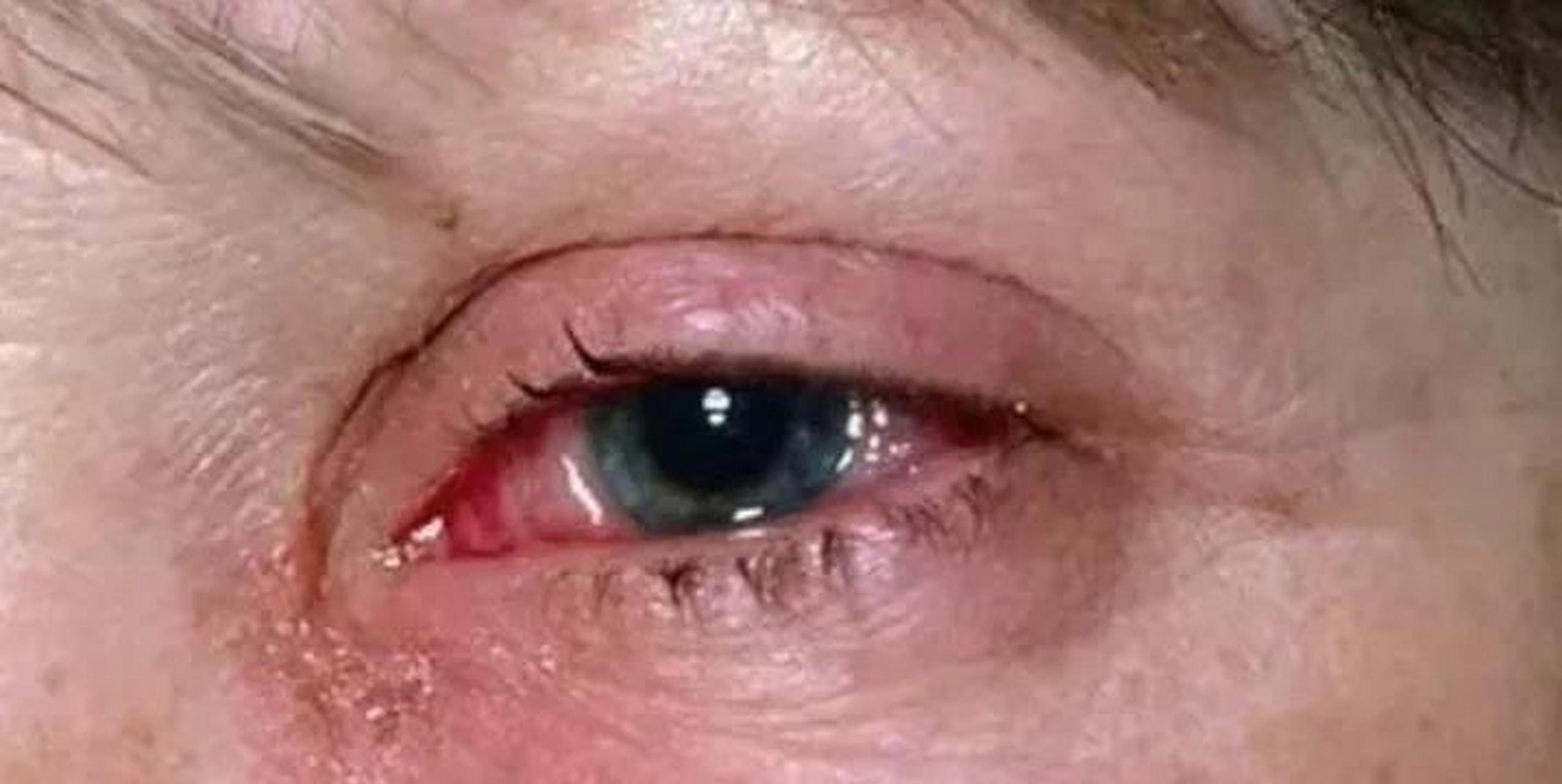 又有新冠新变种传到国内了,有结膜炎症状.