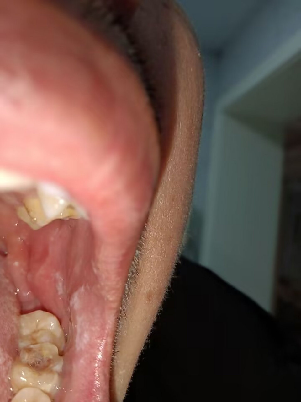 口腔扁平苔藓 出现这几个信号 预示着可能癌变 很多得了口腔扁平苔藓