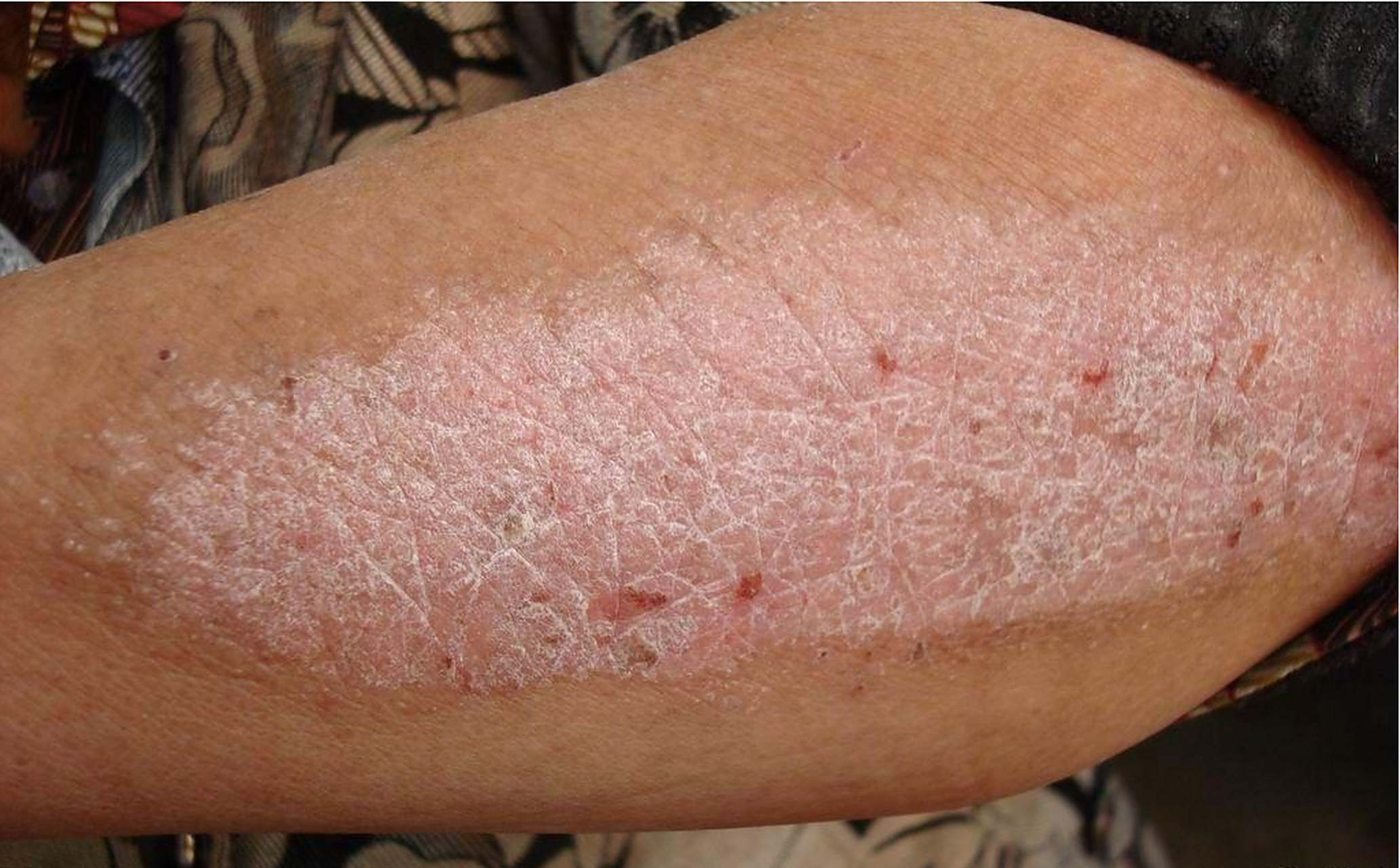 患者的小腿神经性皮炎已经长期存在,尽管用药后有所缓解,但病情仍会