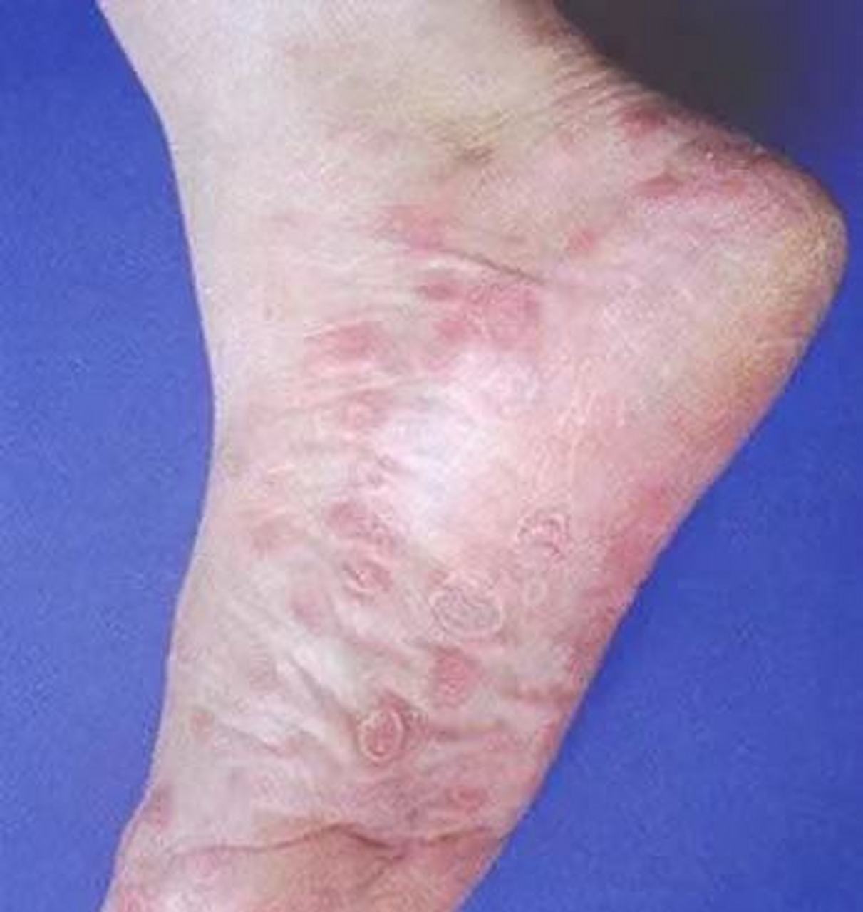 一般两个脚都有,不痛不痒,主要是治疗梅毒(青霉素),皮疹就能消退,这个