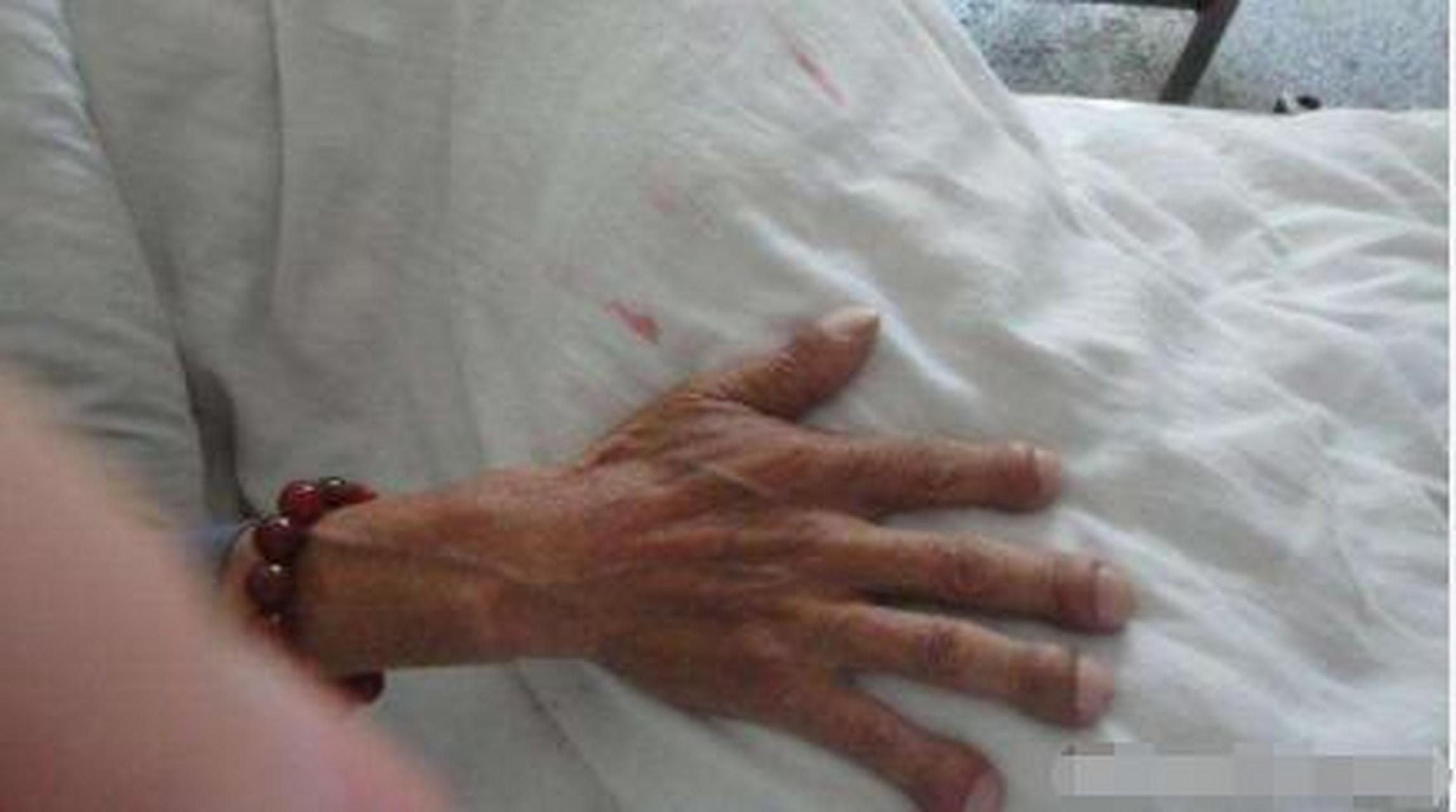 什么是杵状指?其发生的病因是什么,与肺癌有什么关系?