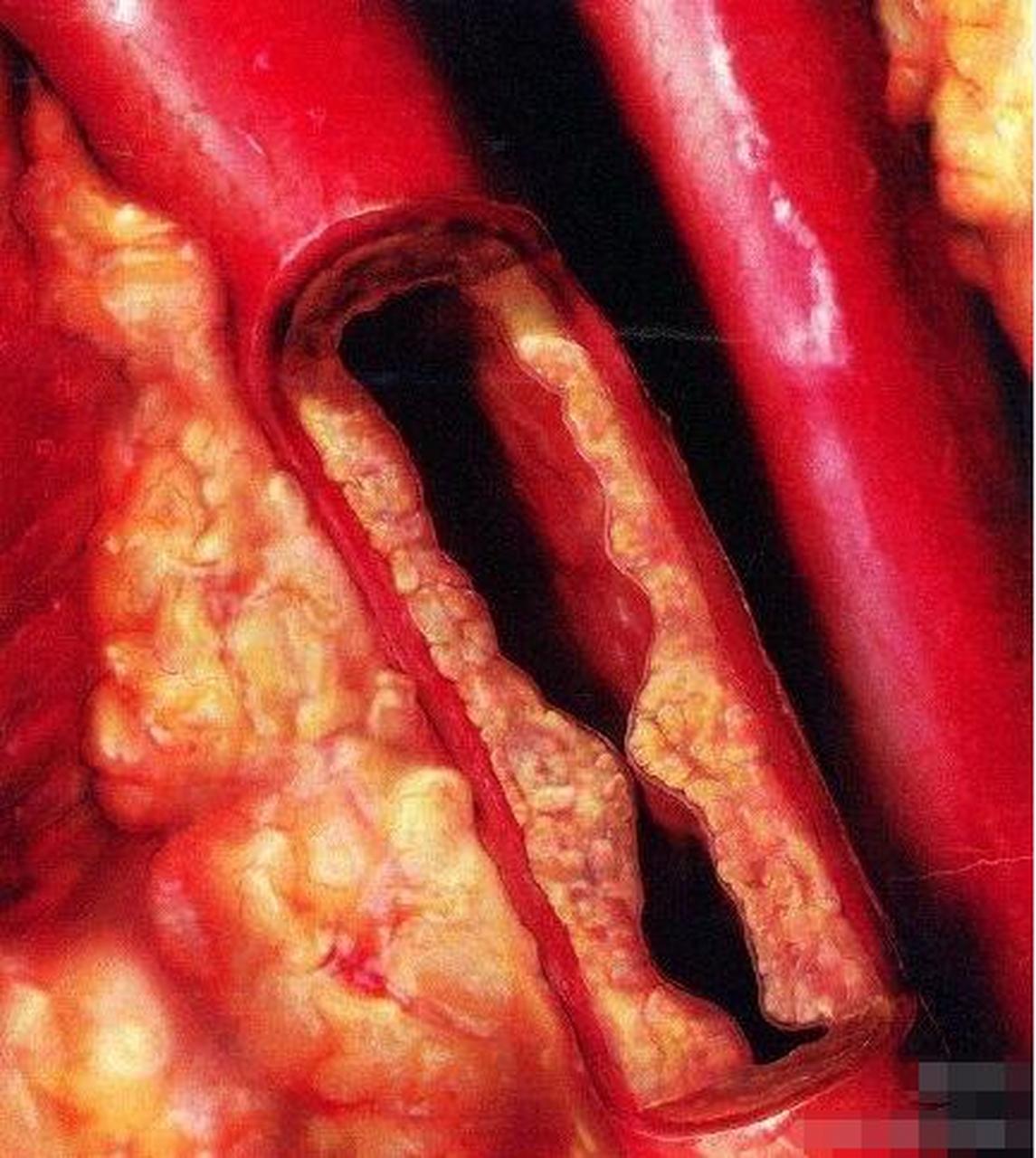 冠状动脉粥样硬化镜下图片
