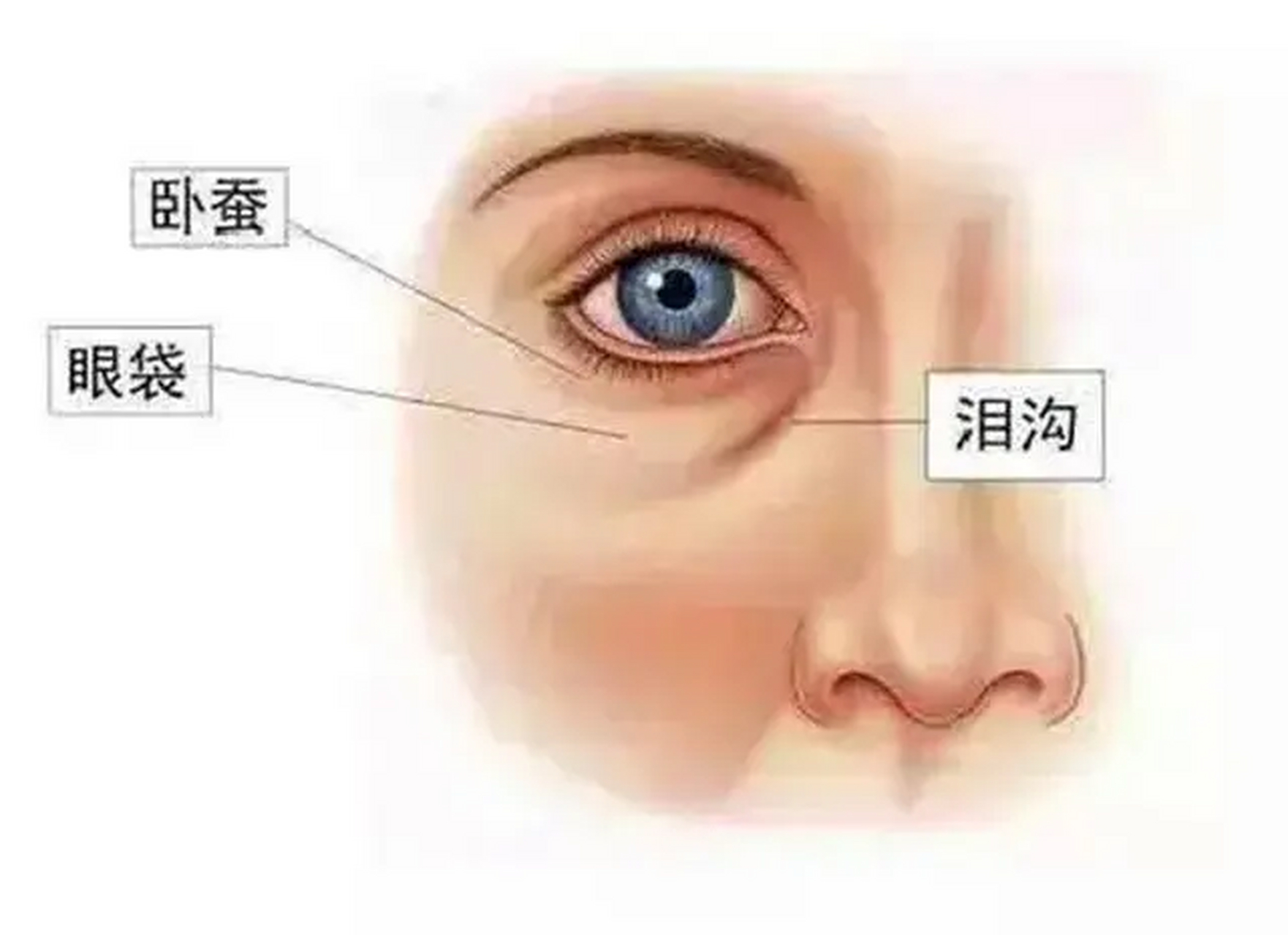 泪沟的类型以及去除办法  1,年轻型泪沟  年轻型泪沟形成的原因则是