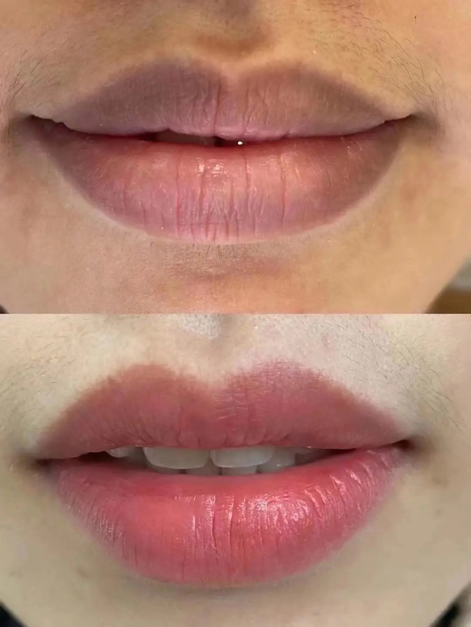 8215去角质 嘴角周围的皮肤很容易因为角质层过厚而