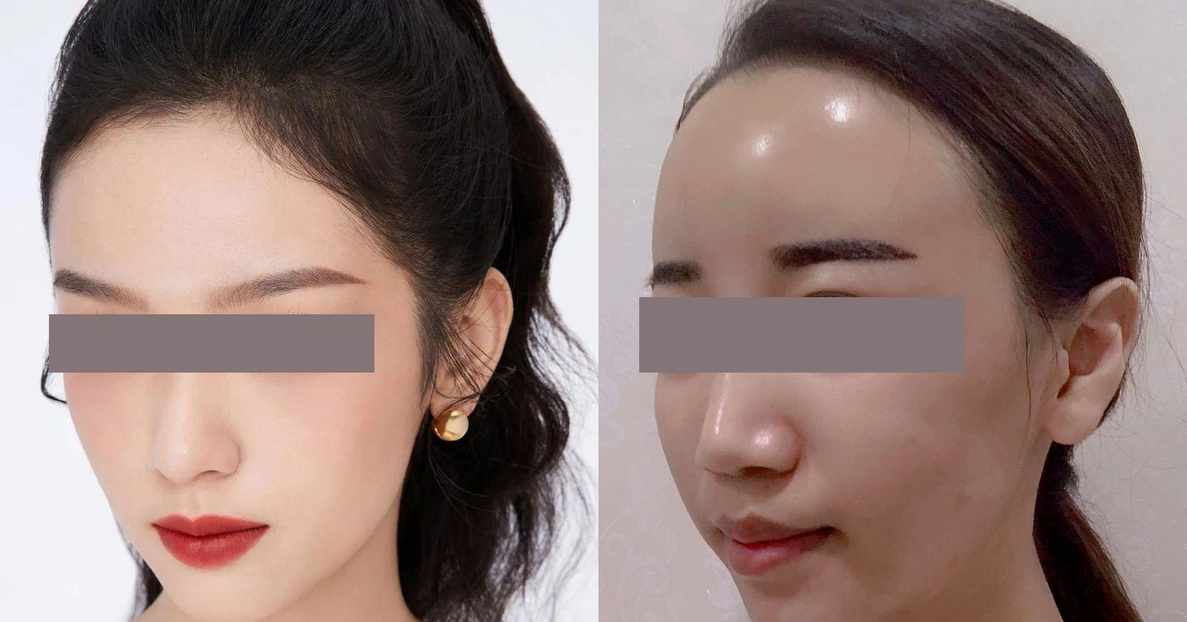 我来助你~  什么样的玻尿酸适合额头填充: 额头的美学特征是展现额部