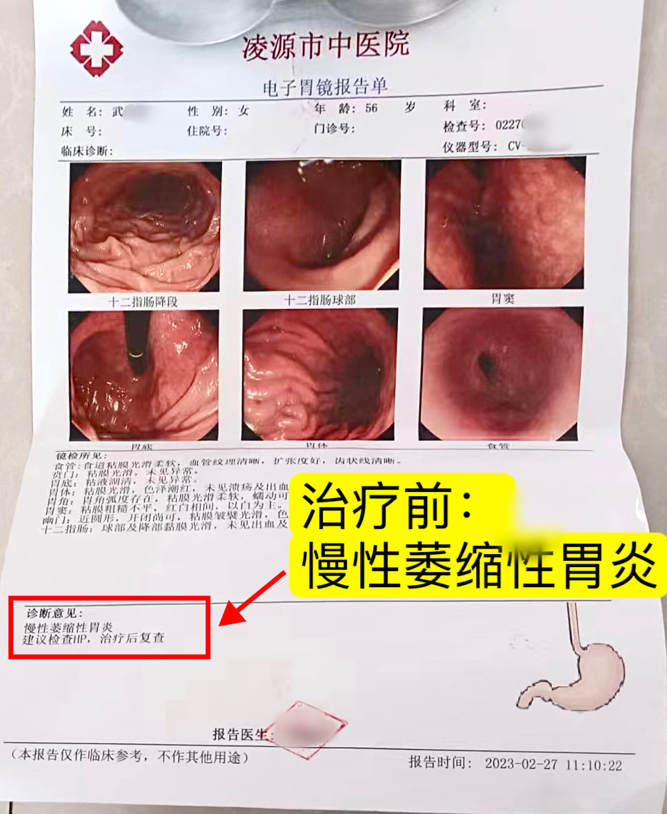 武女士,56岁,胃镜检查报告显示:慢性萎缩性胃炎