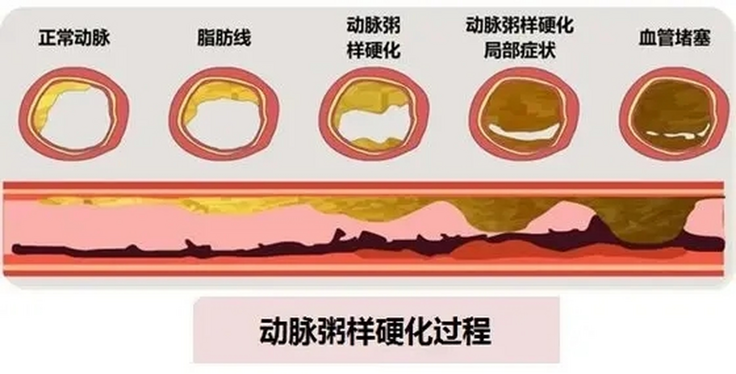 颈动脉狭窄程度图片