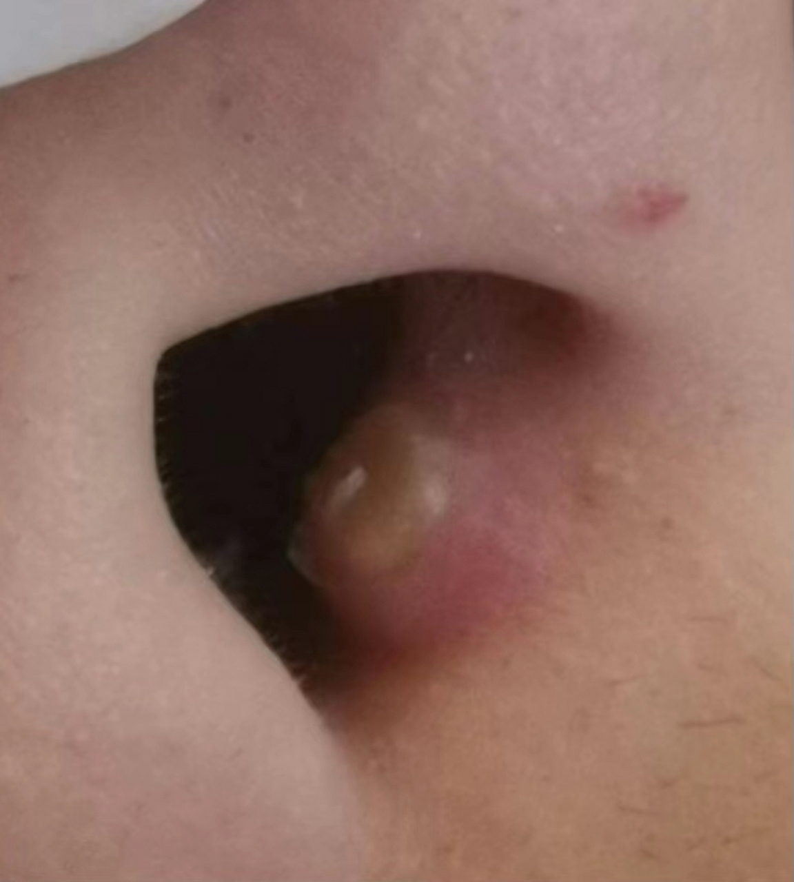 这个位置的粉刺千万别挤,忍住啊!#耳鼻喉# #健康科普