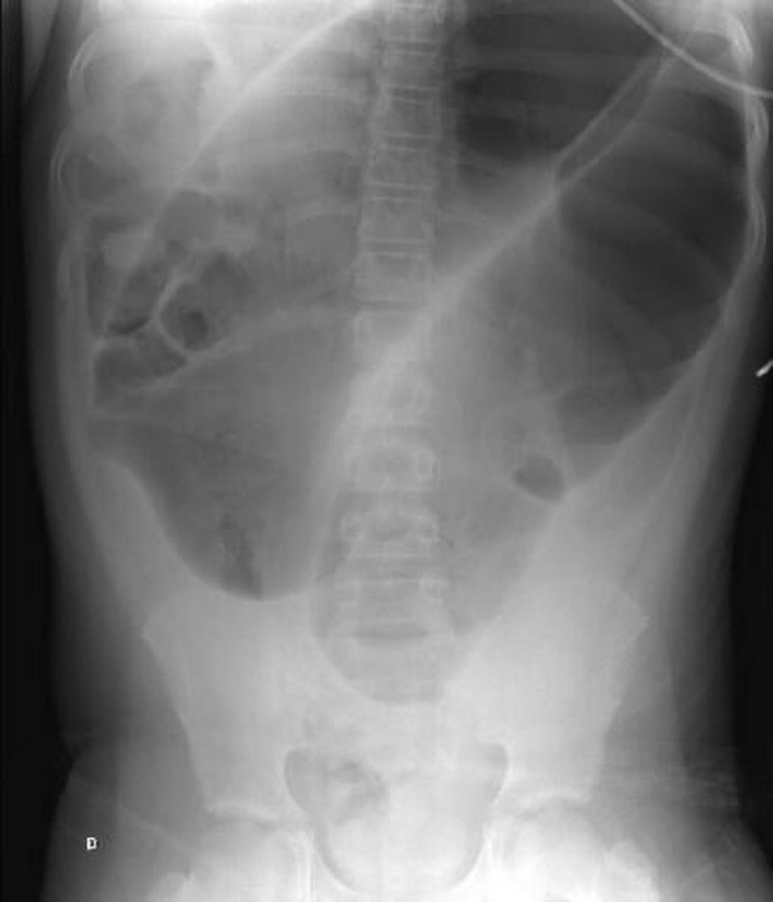 咖啡豆征——乙状结肠扭转的典型影像学表现