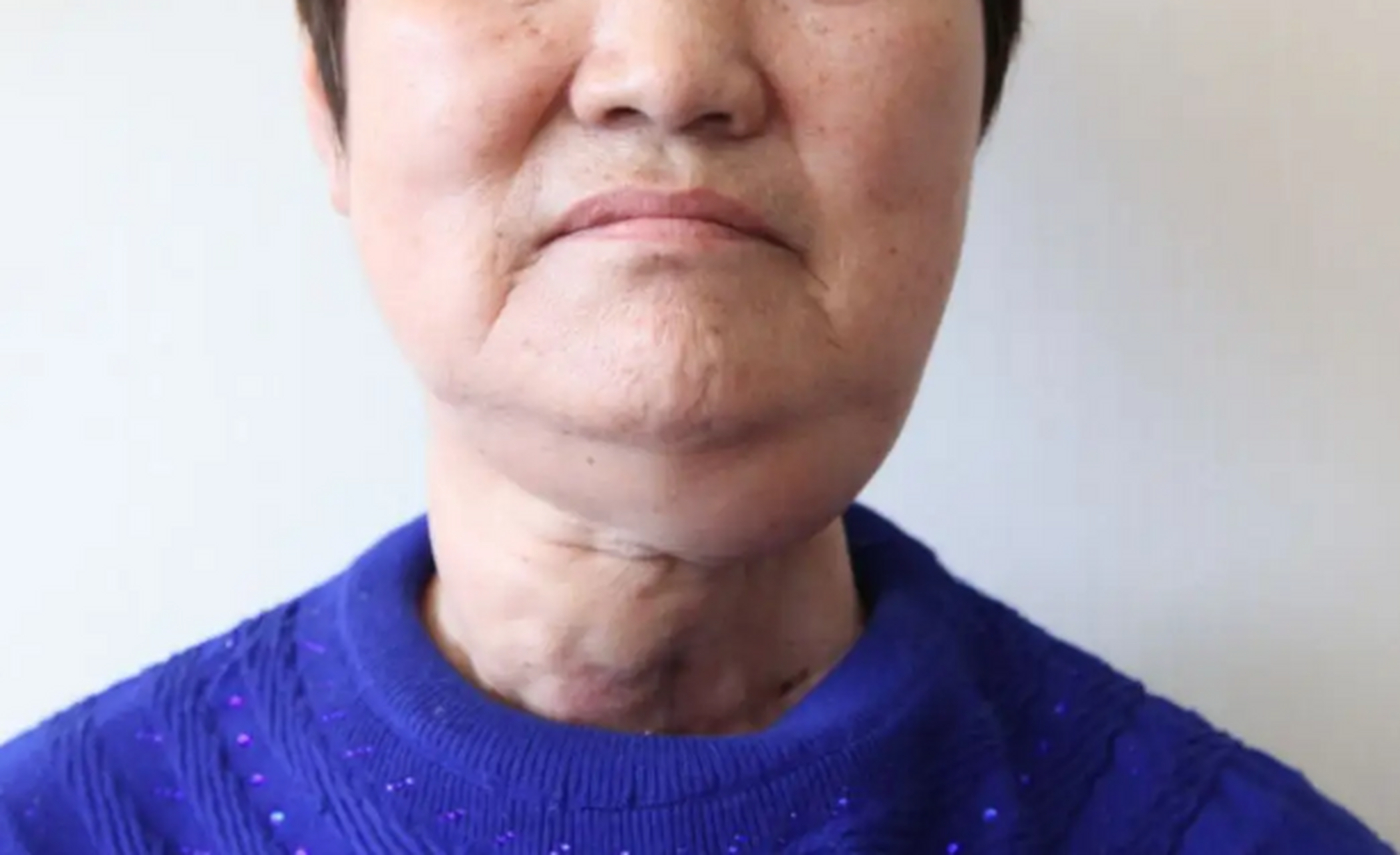 良性肿瘤:比如甲状腺结节,良性甲状腺瘤,经过有效的治疗和观察,可以活