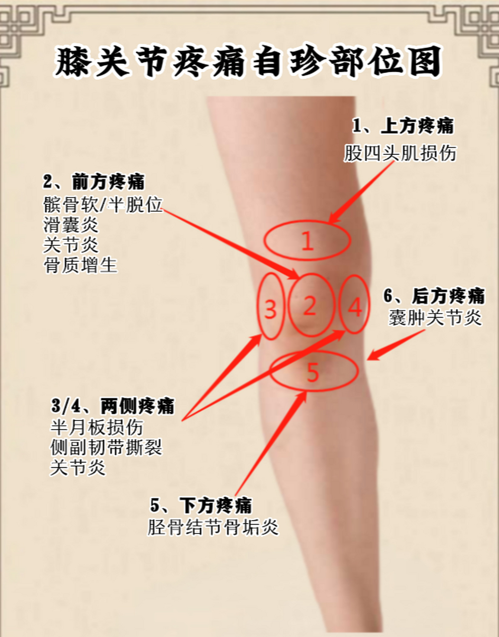 膝盖关节疼痛自诊与调理  1,上方疼痛:股四头肌损伤 2,前方疼痛:髌骨