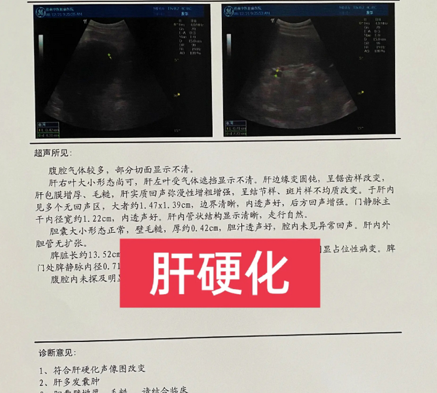 02肝脏彩超,能直接的看出肝脏的体积形态,有无增大或者缩小,或者有