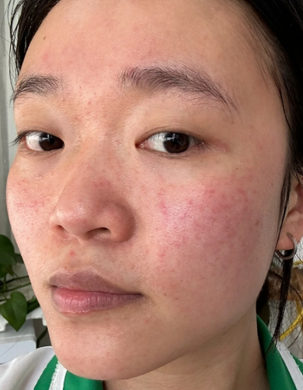 玫瑰痤疮,也称为囊性痤疮或成人痤疮,是一种常见的皮肤问题.