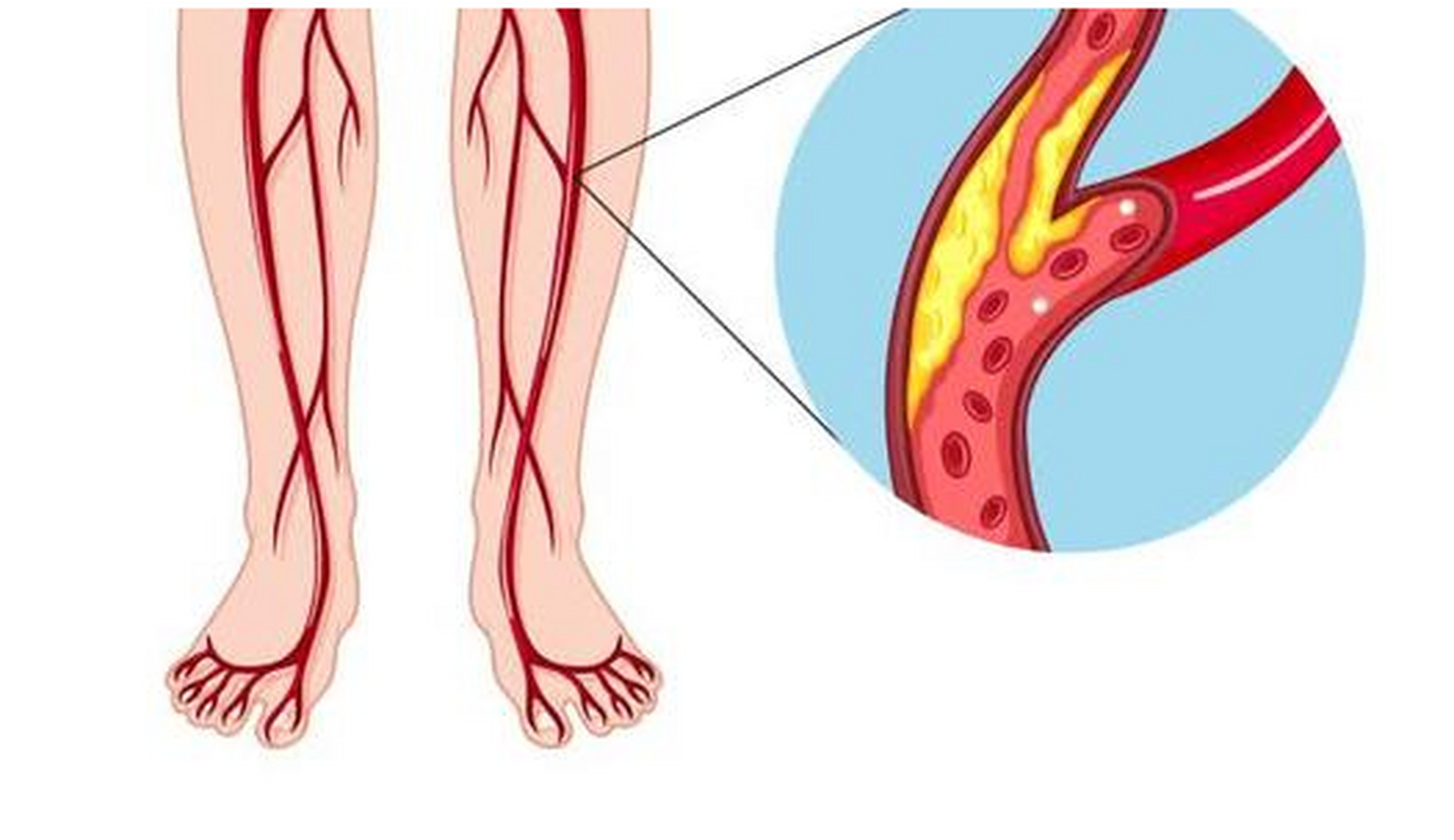 血脂高,身体下肢血管堵不堵,看这几个表现就够了!  1.
