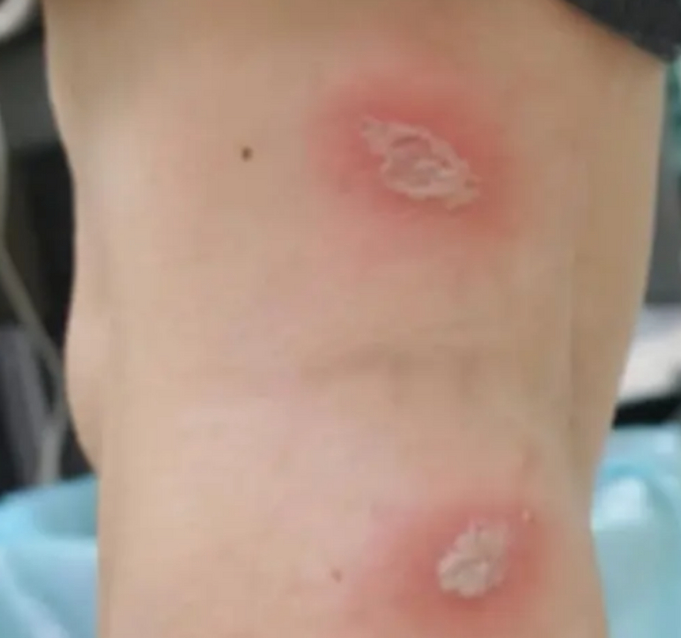 女子捏死隐翅虫手臂被腐蚀7天还没好