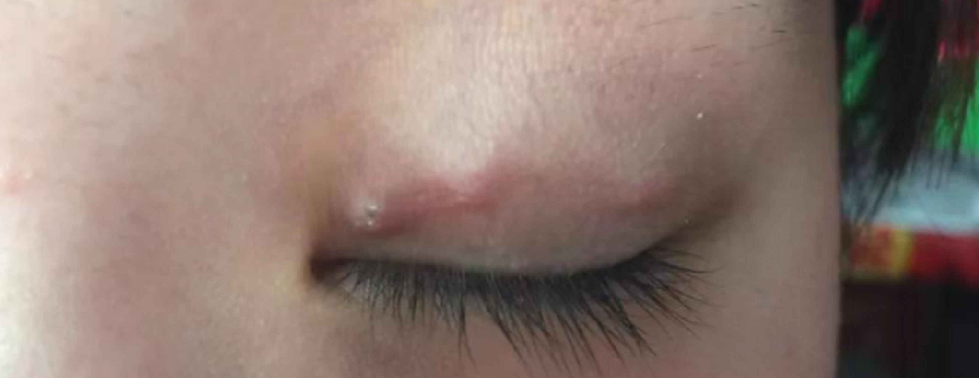 埋线双眼皮# #双眼皮