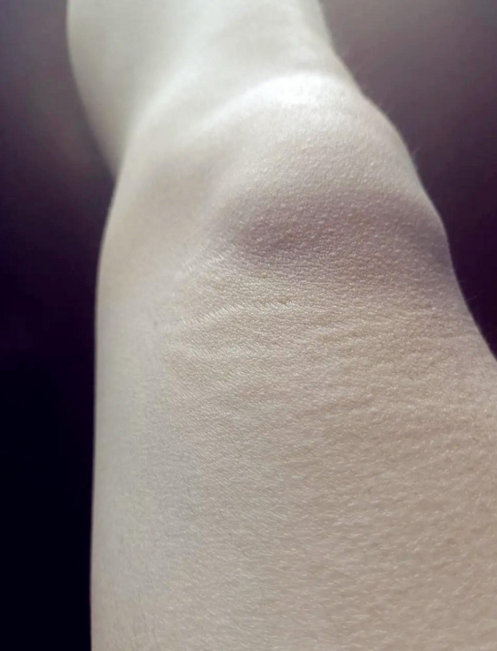 女朋友腿上的这个,是叫妊娠纹么?