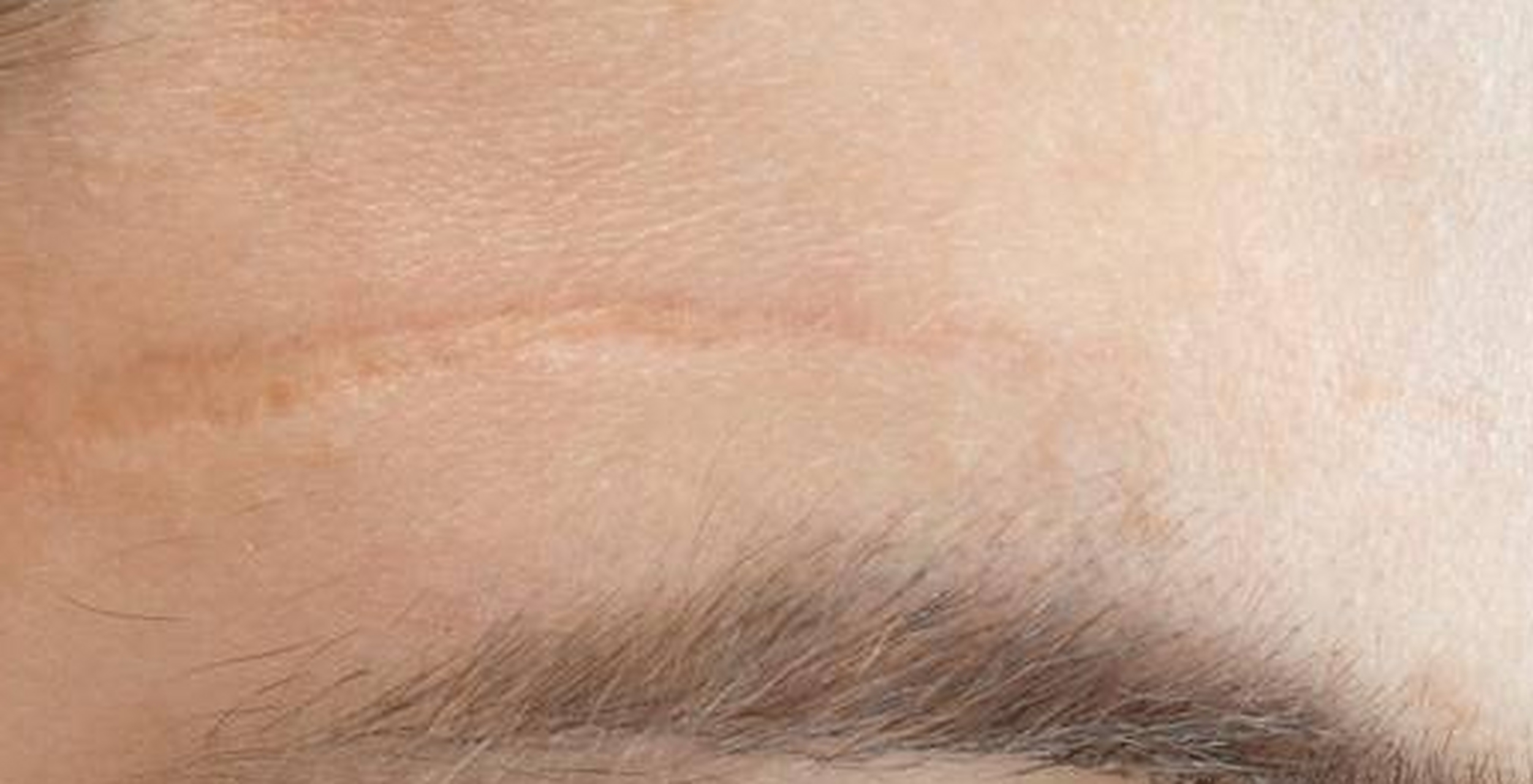 我因为小时候调皮摔了一跤,脸上留下了一个小疤痕,现在长大了开始注重