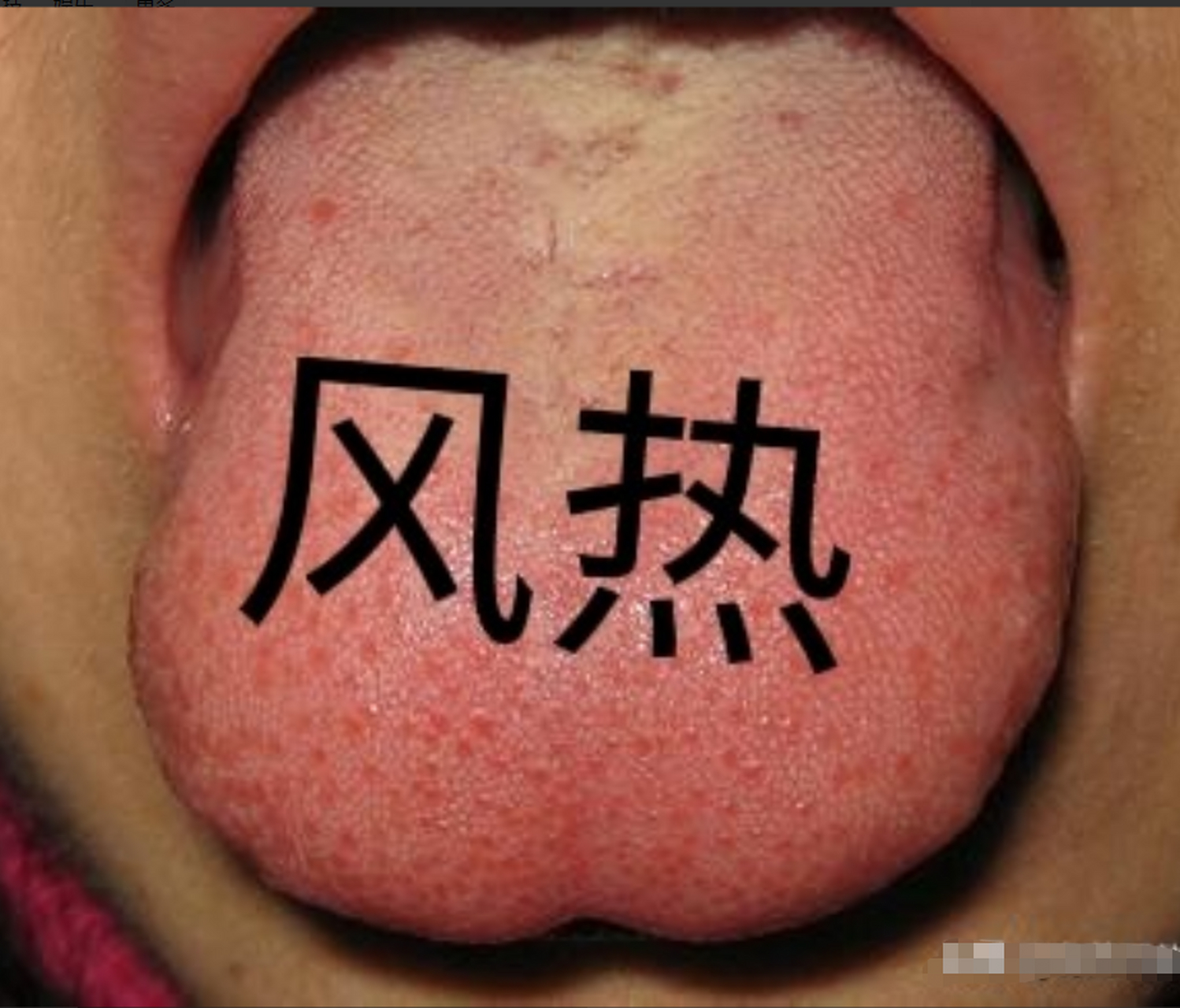 寒咳:以发散风寒,宣肺止咳为主. 舌象:舌质白,苔白腻.