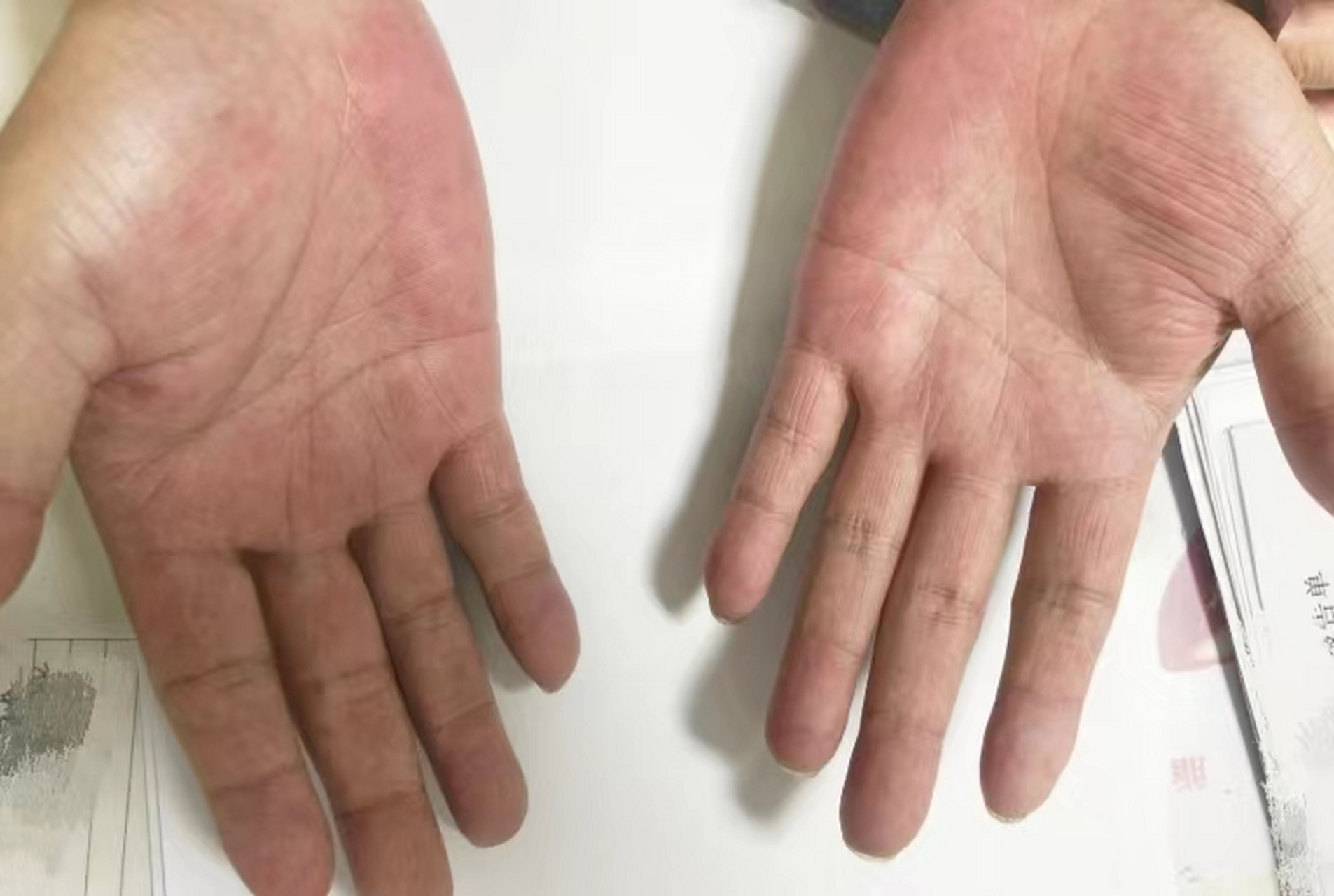 看大叔的手掌已经是明显的肝掌了,自己却没有重视,直到因为身体不适被