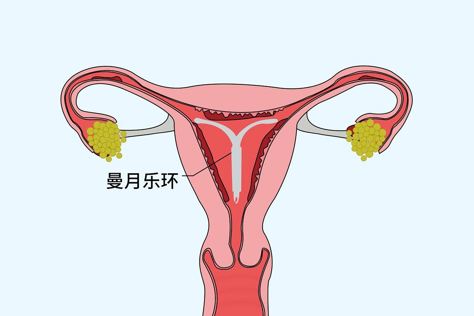 乐环对"腺肌症"的负面影响不容忽视,你注意了吗  #腺肌症# #上海子宫