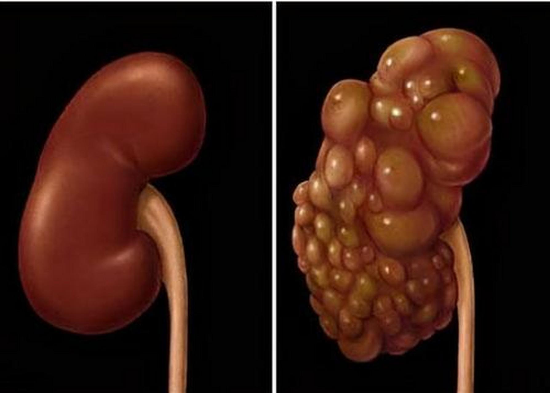 有一些类型的肾囊肿是会导致肾癌的,这就要关注囊性外皮的厚度,肾