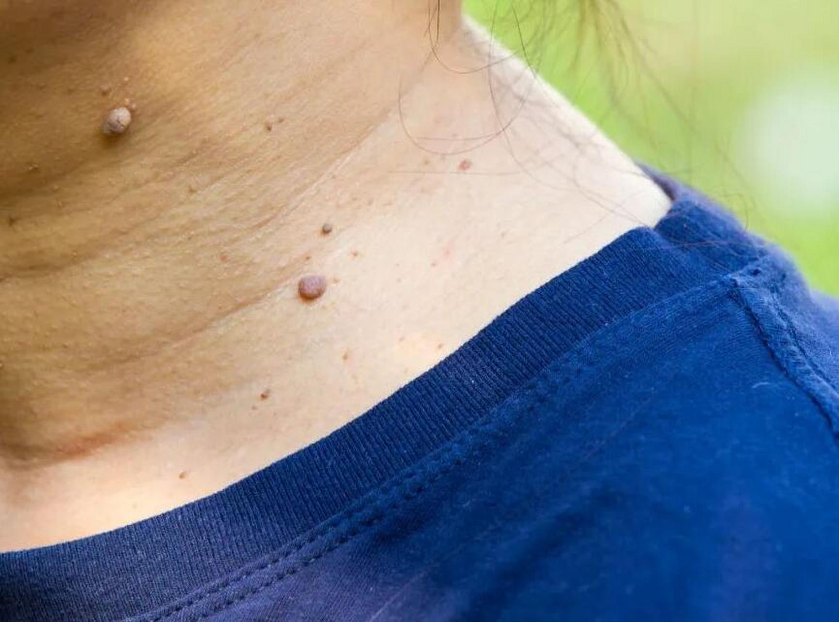 皮肤上长出肉疙瘩,多出现在中年妇女人群身上,最近门诊也多了几位