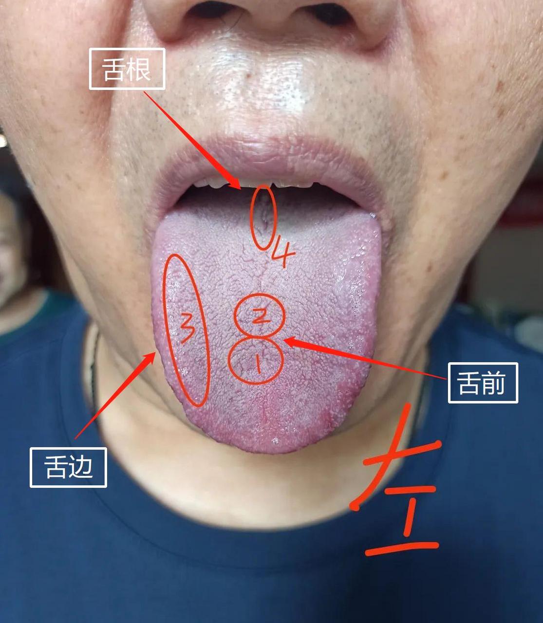 昨天遇到一位病友,舌头上的小裂纹很多,心脏也有不适感 标记1:此区域