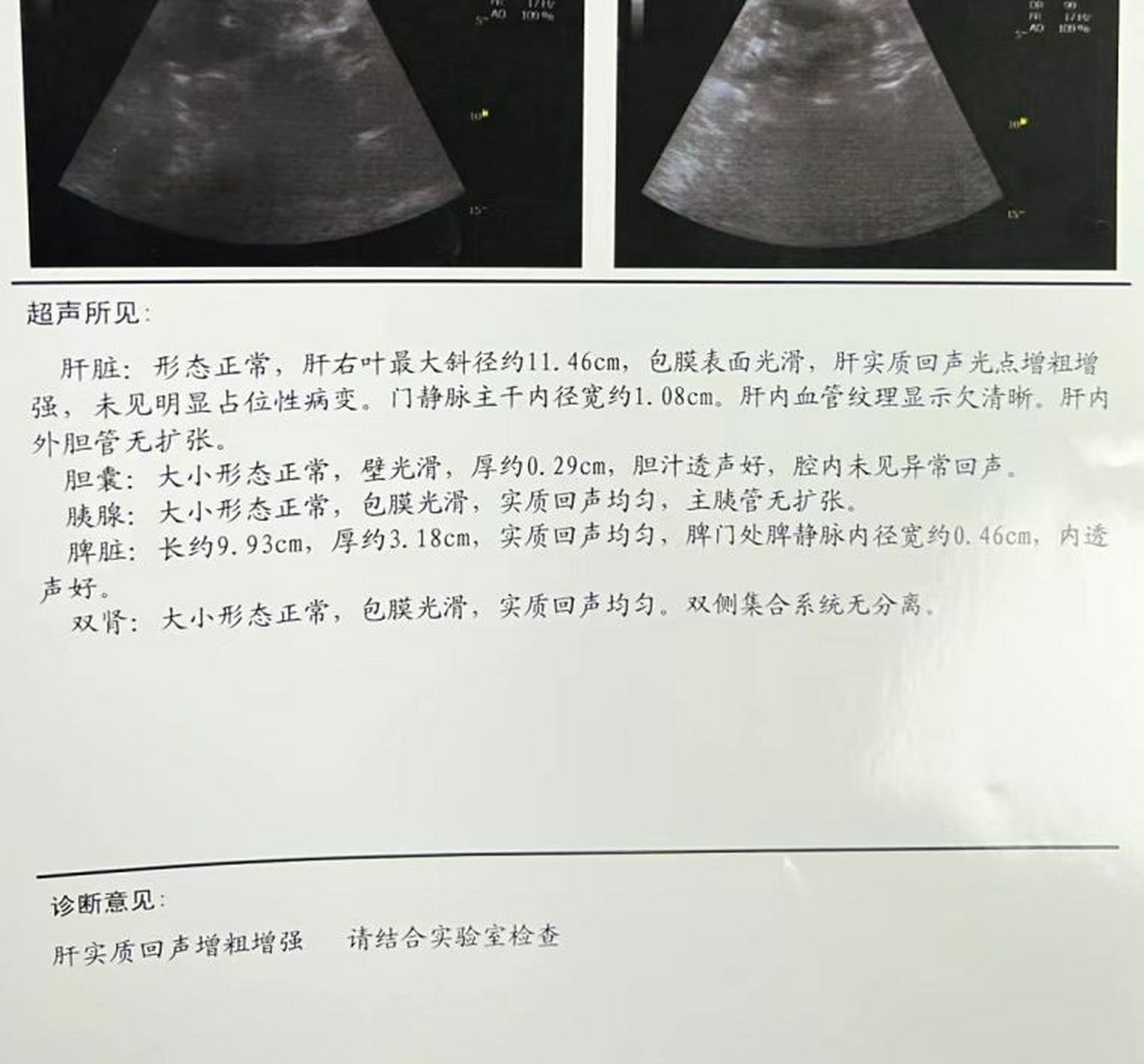 相信肝病朋友们都在在彩超上看过肝实质回声增粗增强的描述,其实这是