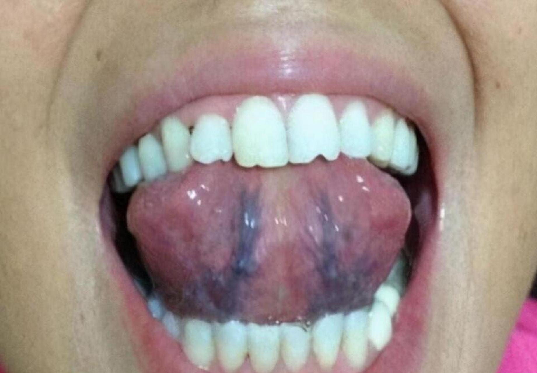 肝经淤堵,舌下青筋发黑,女性经常生气就会导致气滞,气不足就没办法