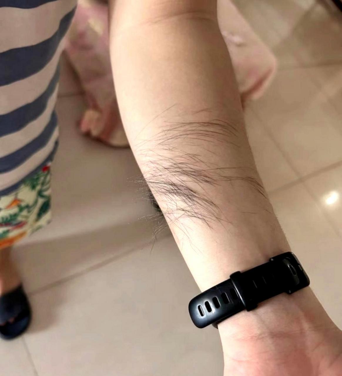 一觉醒来,发现胳膊上多了一片茂密的汗毛,该怎么办呢?急需解决方案!