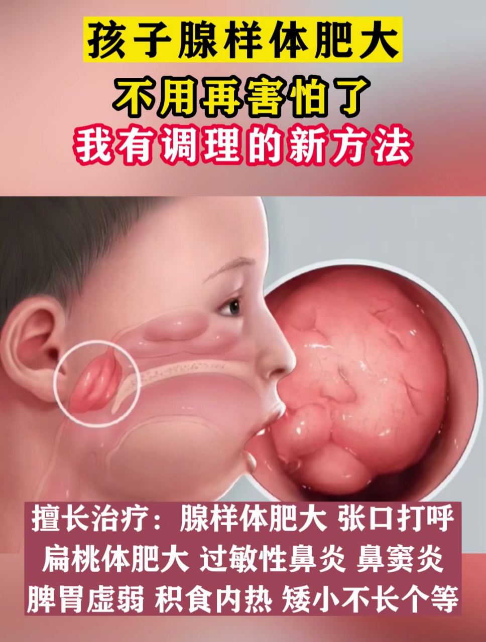 分享一个治疗腺样体肥大的临床验方,这个方子对于小儿过敏性鼻炎同样