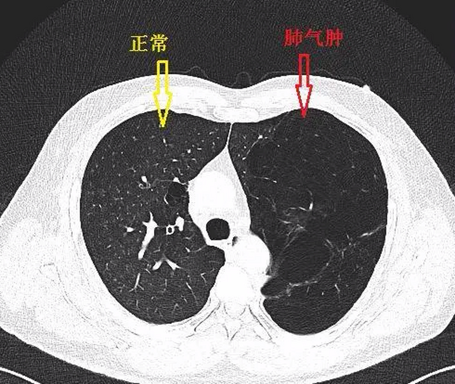 正常的肺和肺气肿图片图片