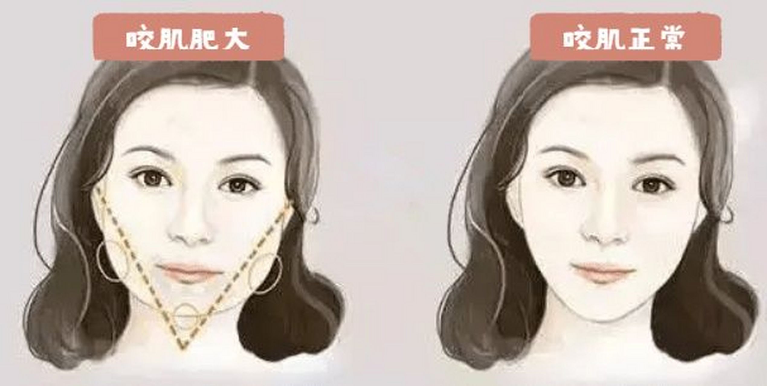 方脸怎么区分是骨骼大还是咬肌大?