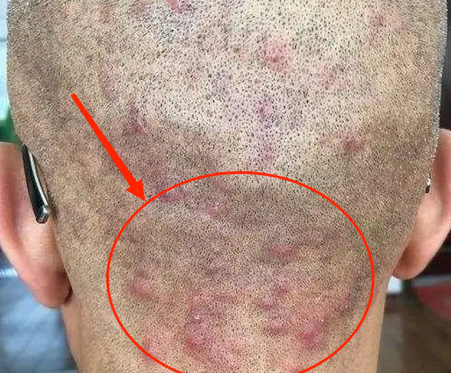 头上长红疙瘩,脓疱,脓包,白脓头,伴疼痛和瘙痒感,这是毛囊炎的的
