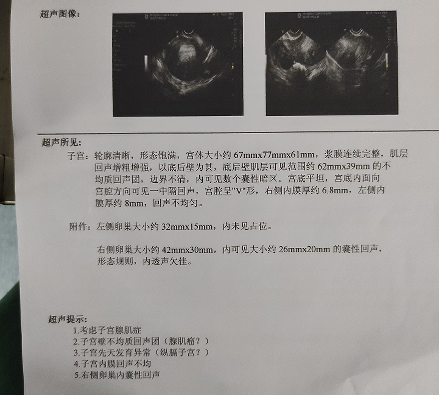 双子宫超声报告模板图片