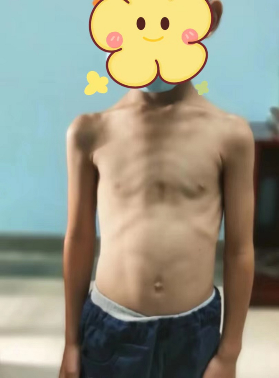 6岁男孩瘦的皮包骨,体重还不到30斤,典型的胃强脾弱,你家孩子这样吗?