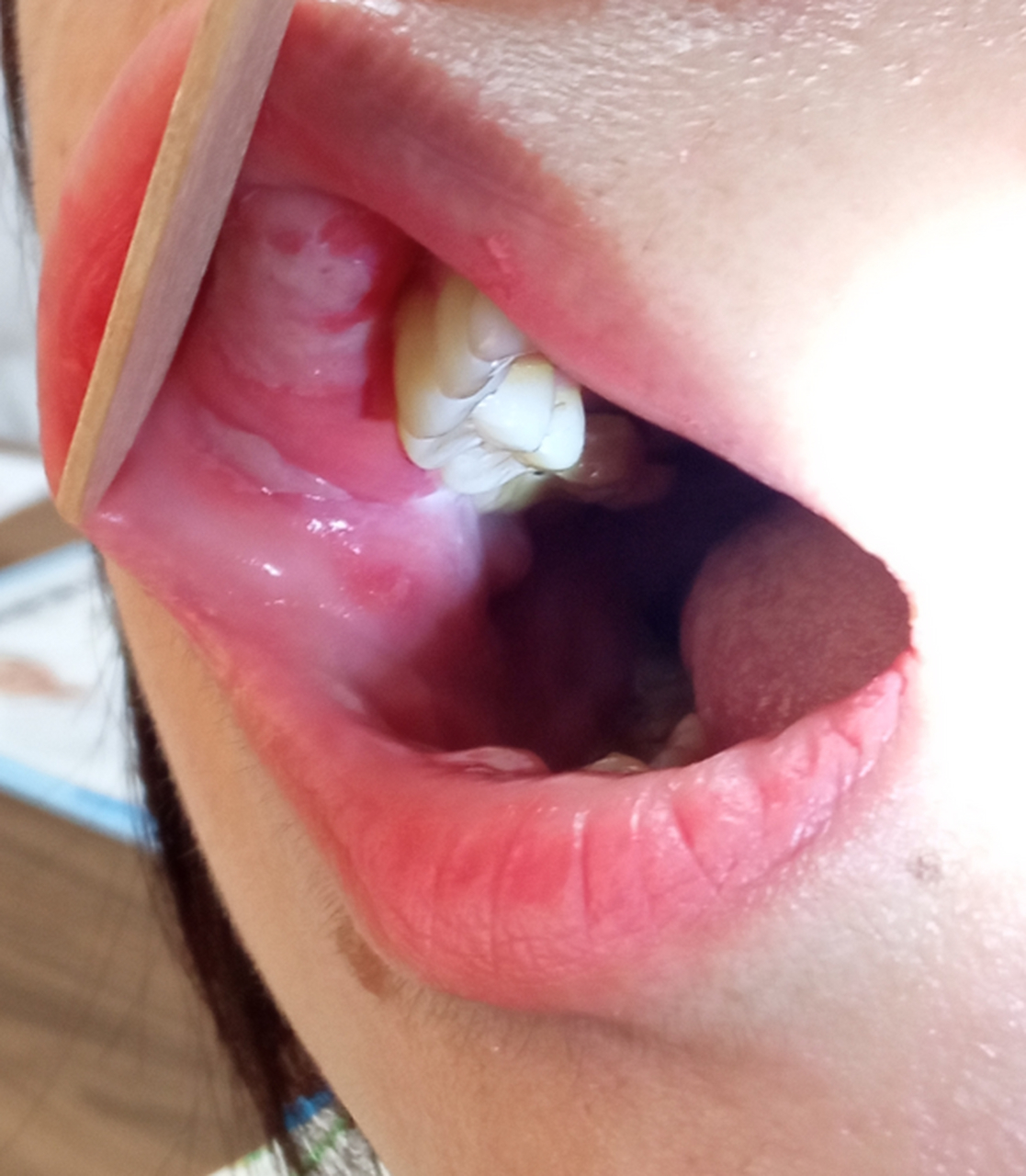 "我嘴里为什么有白色的网?不会是癌吧!