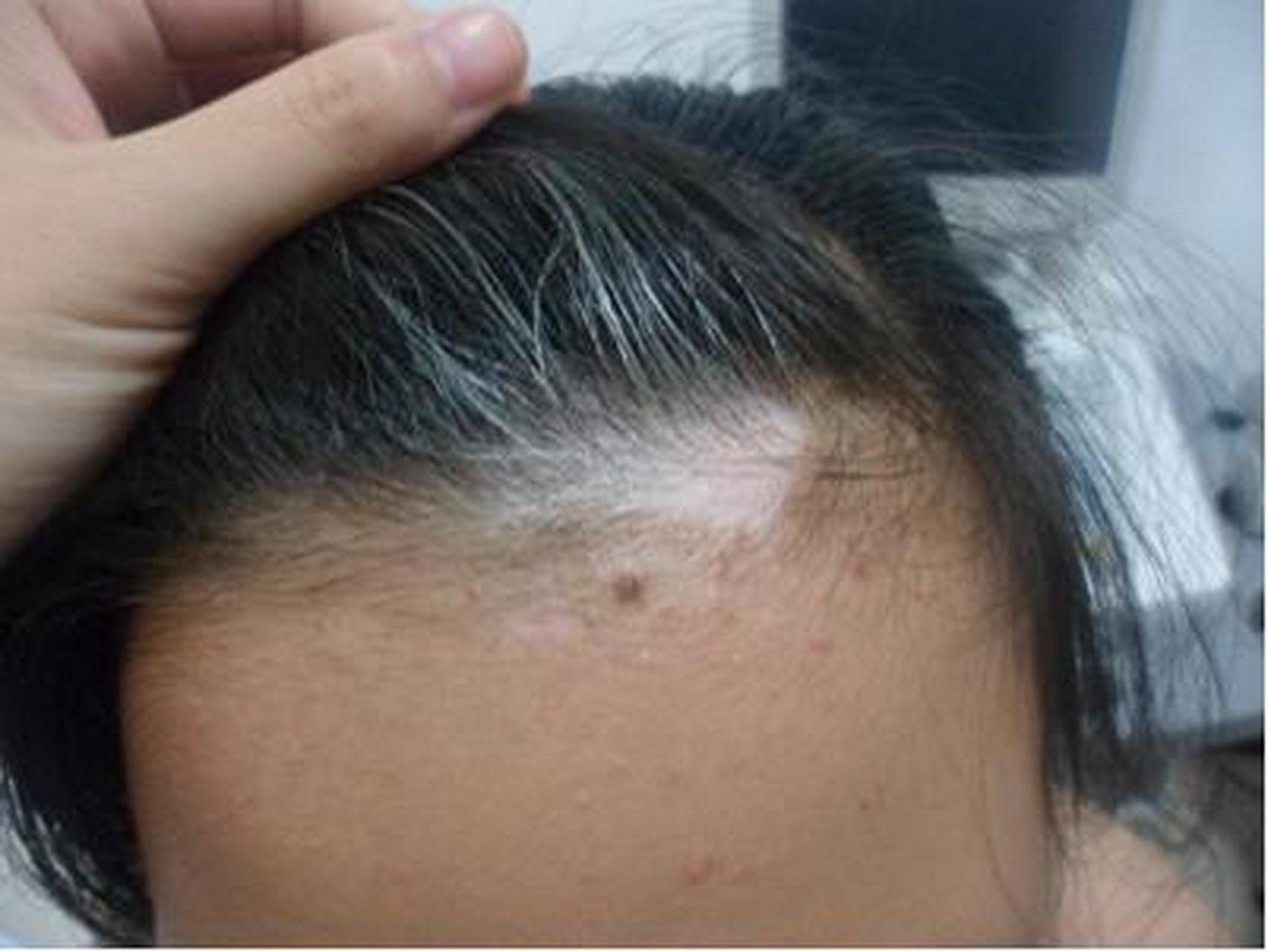 头上的白斑,有好的治疗方法吗?