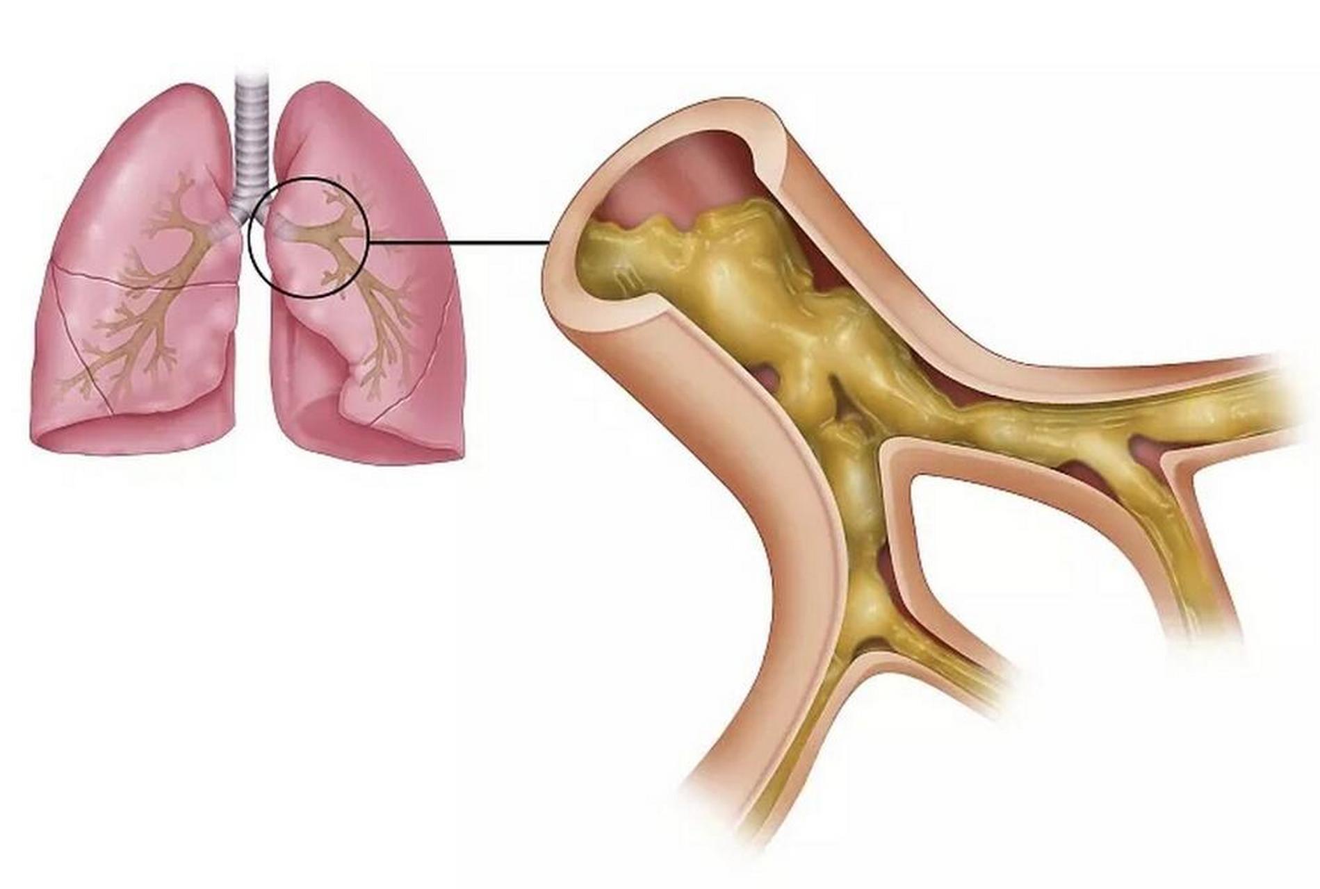 慢性支气管炎 支气管哮喘 轻度肺气肿,建议存一下这个方子 56岁的马
