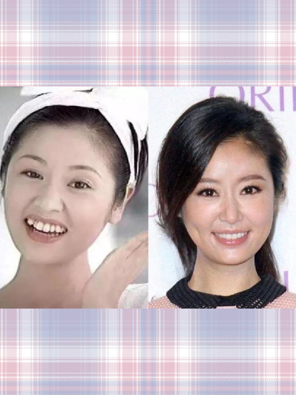 明星整牙前后的变化 整牙=整容 拥有一口漂亮的🦷,会变得更自信更爱