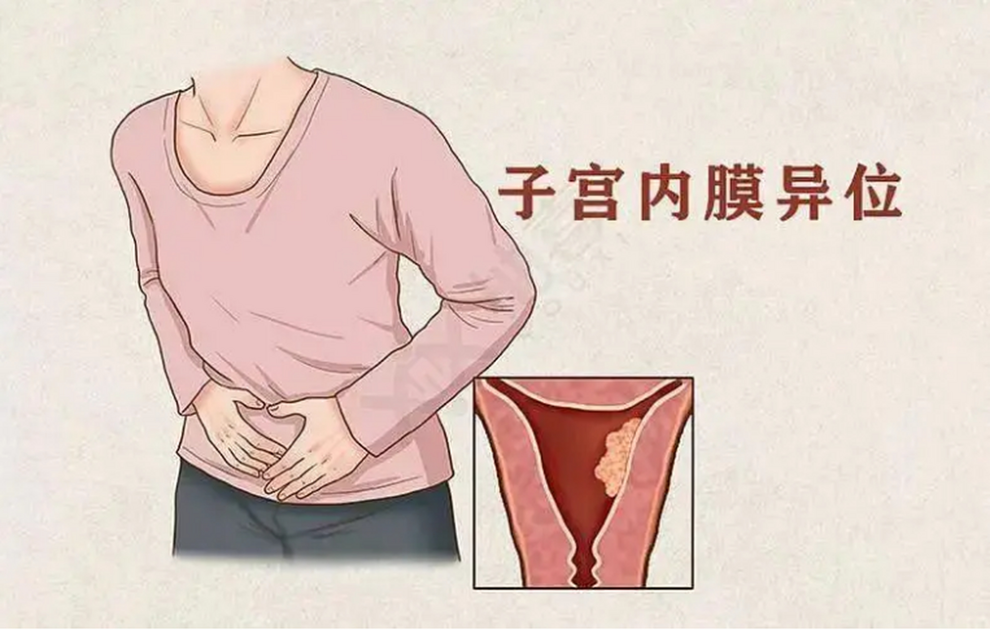 子宫内膜异位卡通图片