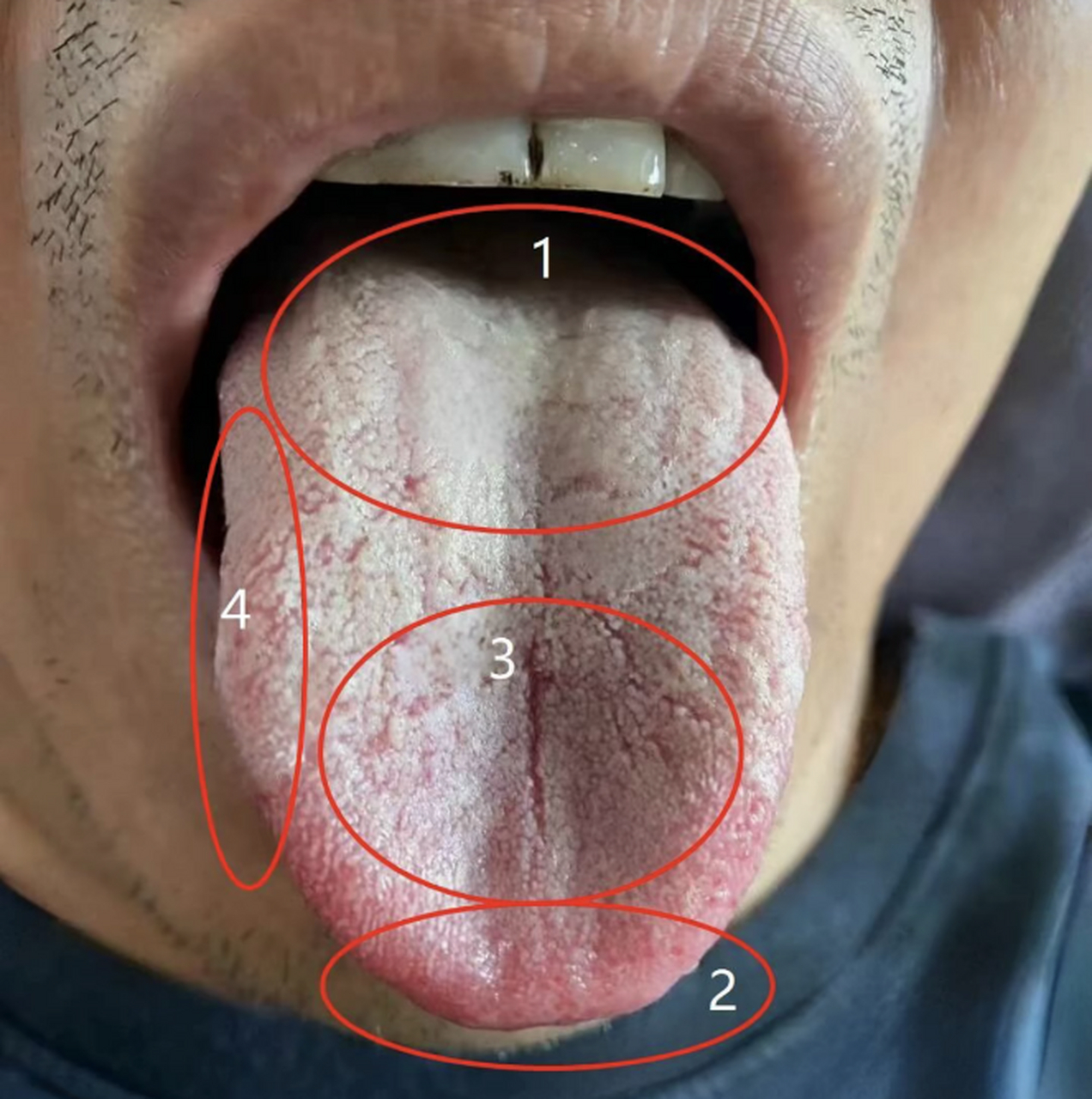 每日舌苔分析:心慌胸闷,口苦口干,寒热交错  症状:欲望减退,时间缩短