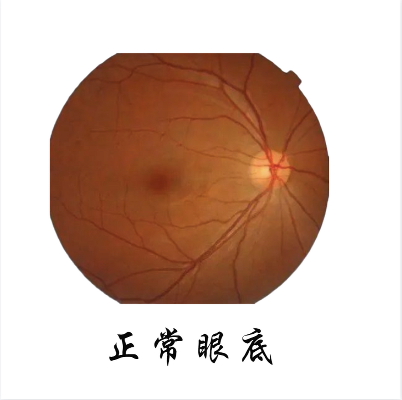 视网膜是我们眼球内部的一个重要结构,它与我们的视力密切相关如果