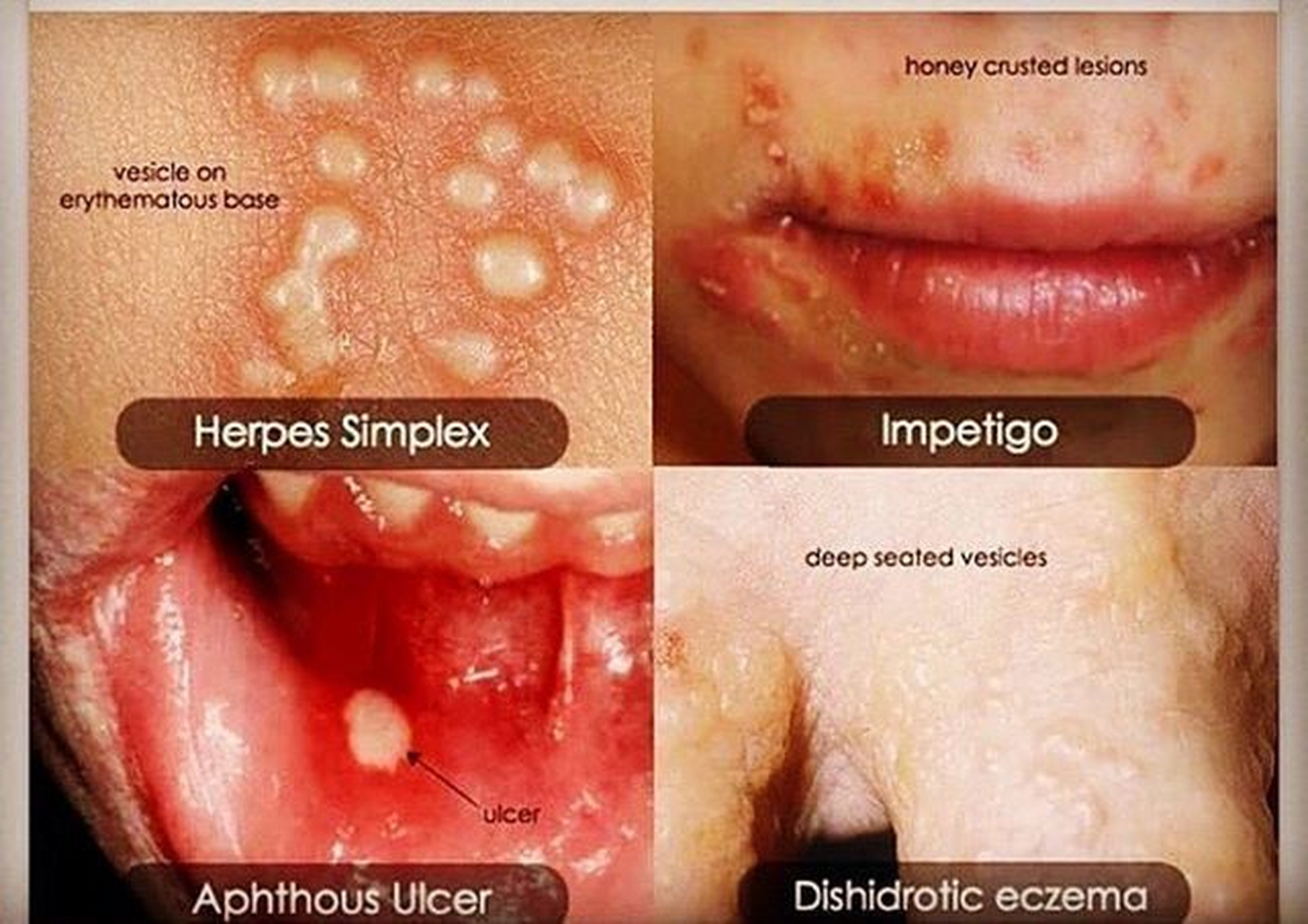 你肯定经历过其中的一种:单纯疱疹(左上),脓疱疮(右上),口腔溃疡(左下