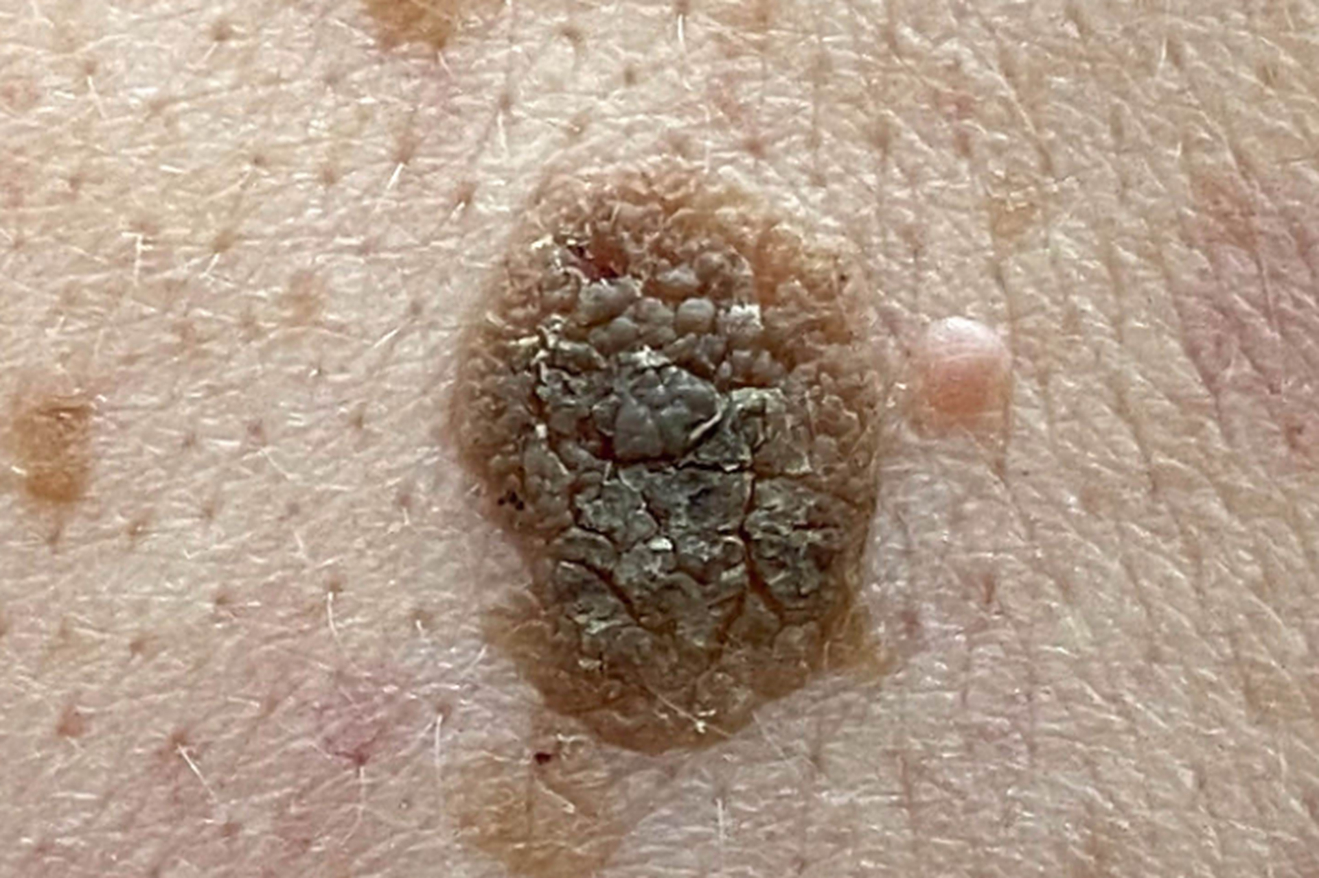 扁平疣,扁平苔癣和老年疣,有何关系?