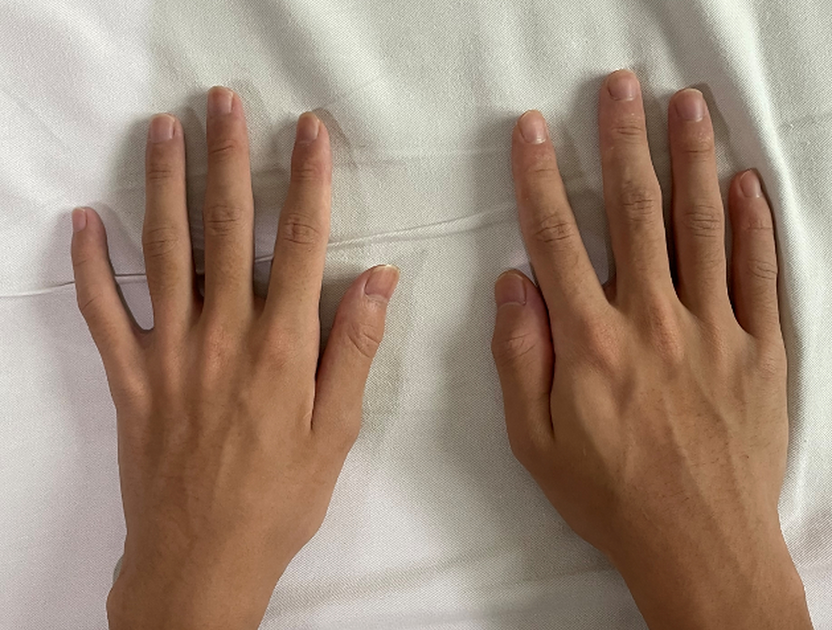 1年前出现左前臂无力,逐渐出现手部及前臂肌肉萎缩,伴左手震颤,冬季