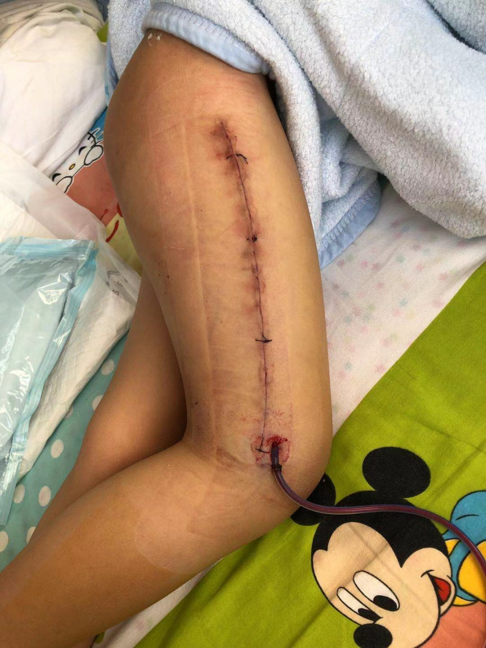 9月25号中午在吉林省白山市靖宇县"成长幼儿园"室外活动把大腿摔折了