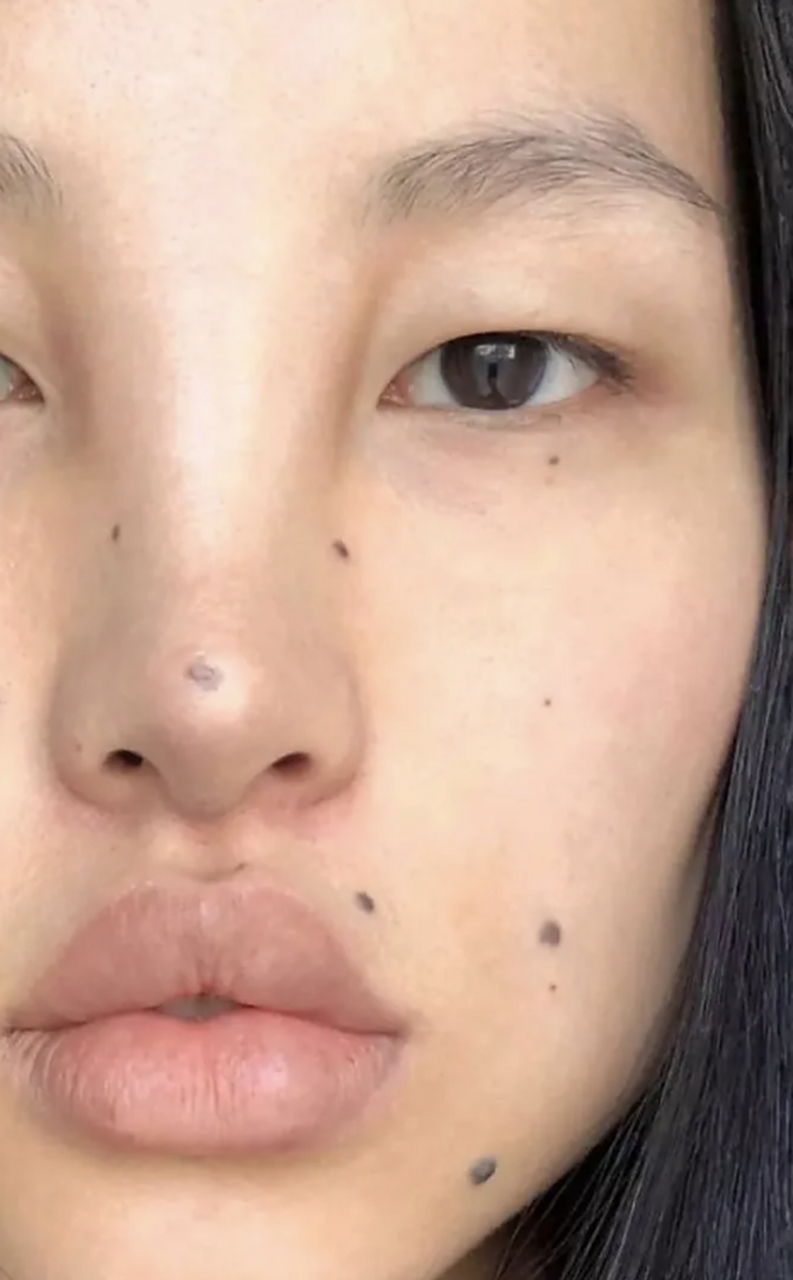 激光点痣# 黑色素痣如何去除根治 黑色素痣虽然对