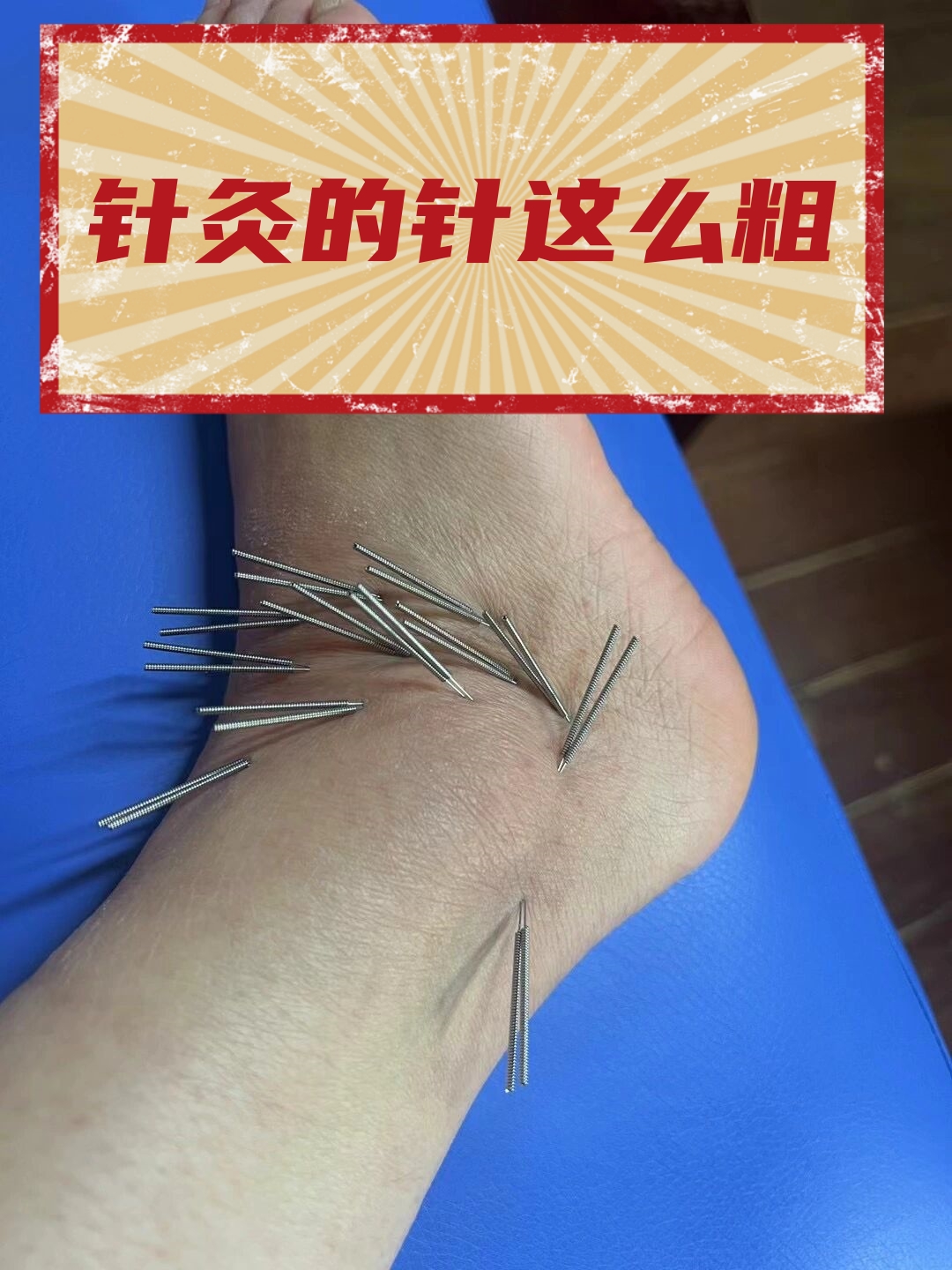 针灸的针这么粗